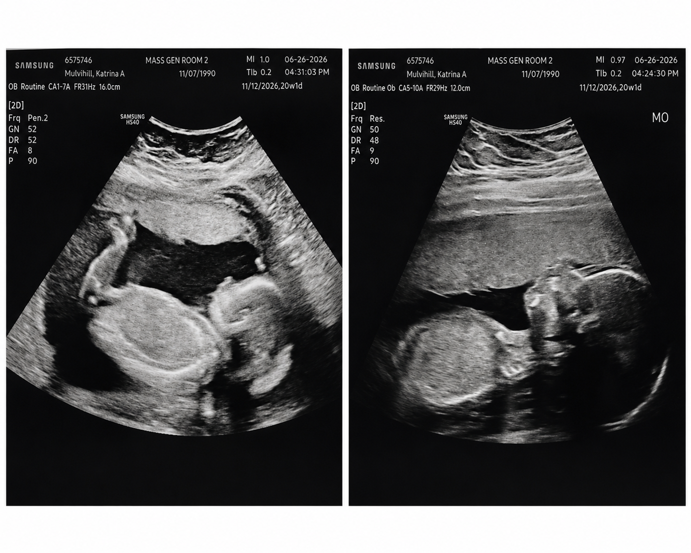 Ultrasound photos of baby girl at 20 weeks